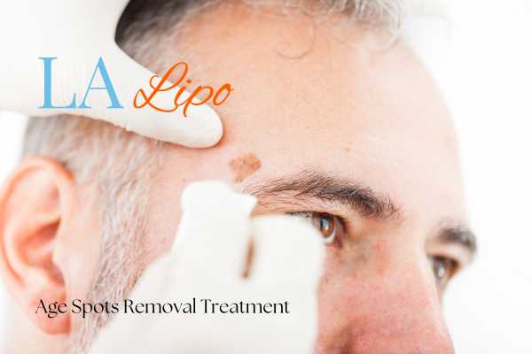 What Are the Most Effective Treatments for Age Spots West Kilburn?