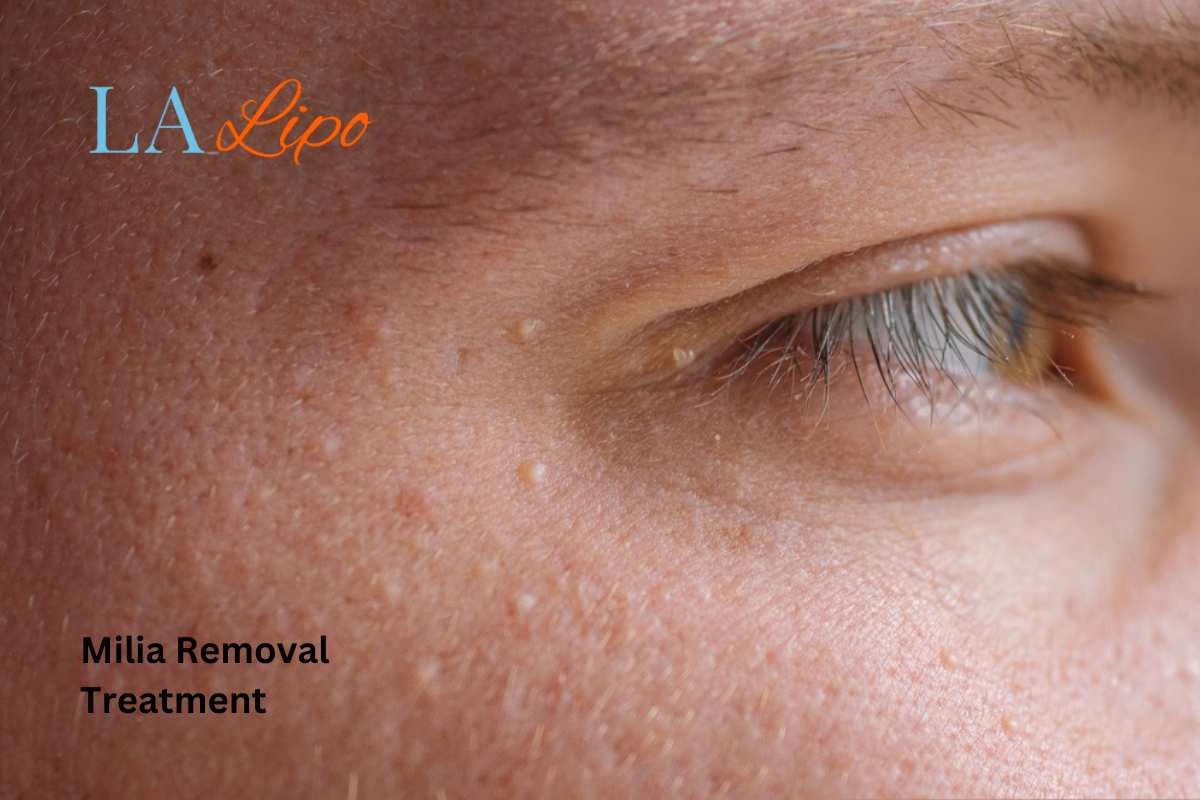 Cryopen Milia Removal: Is It the Easiest and Safest Option West Kilburn?