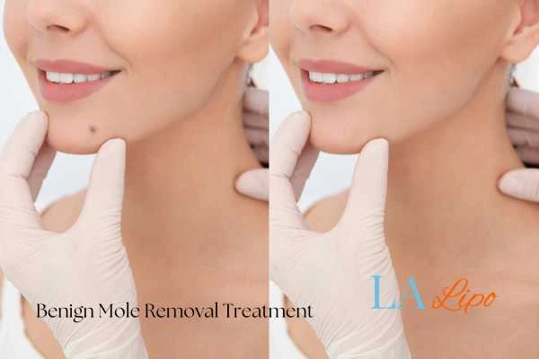 woman's before and after mole removal West Kilburn results