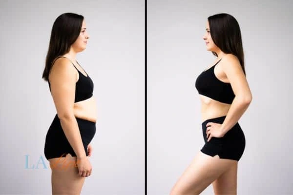 image of woman before and after results of LA-EMS Body Sculpting West Kilburn to help treat Diastasis recti