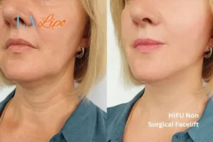 hi-fu for wrinkles West Kilburn before and after results