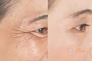 Before and after results of woman - HI-fu wrinkles reduction treatment West Kilburn