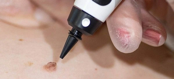 skin tag removal using cryopen West Kilburn