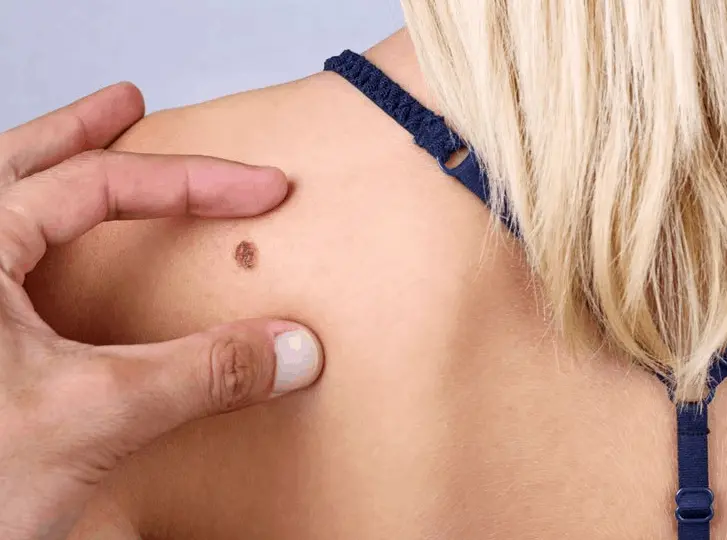 woman having mole removal West Kilburn consultation before treatment.