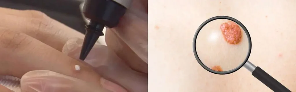 Cryopen for mole removal West Kilburn - speak to our team today!