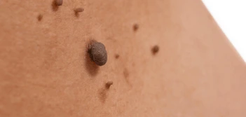 image of a skin tag West Kilburn