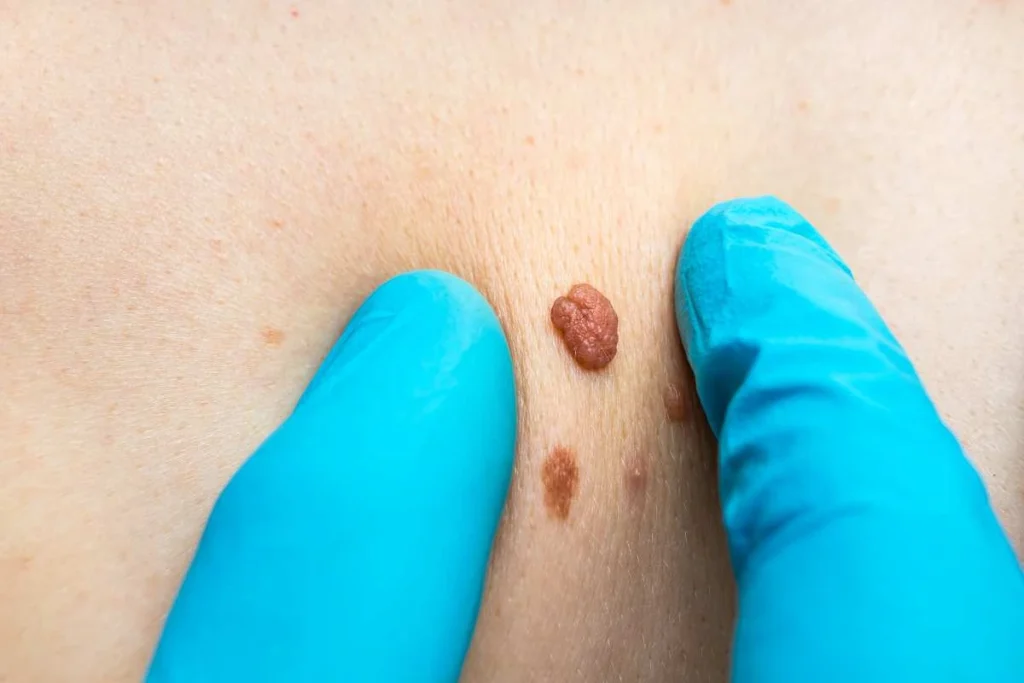 Consultant examining a skin tag West Kilburn