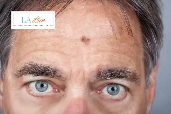 Solar Lentigo Removal West Kilburn image of man with mark on his forehead