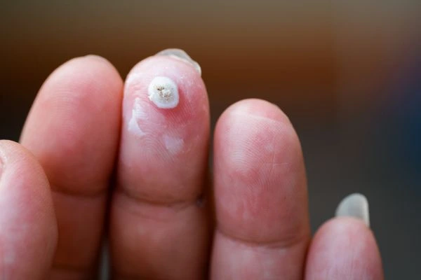 wart on person finger - cryotherapy to treat from LA LIPO West Kilburn