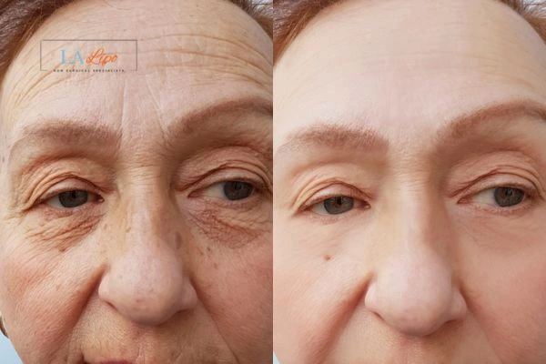 The powerful benefits of Morpheus8 Treatment West Kilburn - Call Our team today!