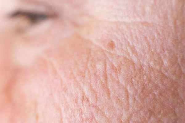 close up picture of a woman's face showing an age spot West Kilburn
