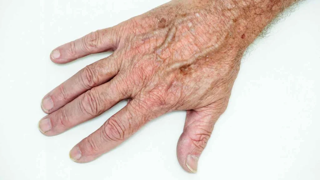 Male hand showing age spot West Kilburn