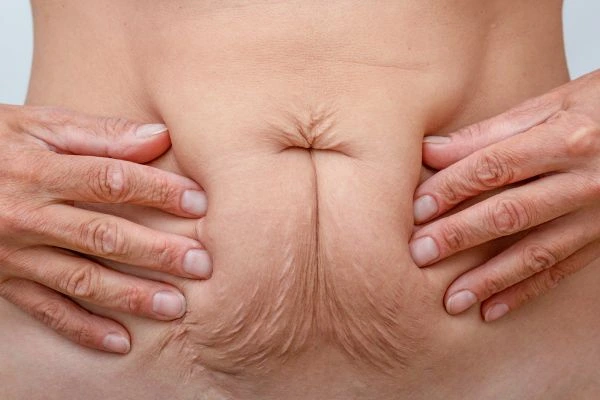 Should I Combine Diastasis Recti Treatment with Body Contouring for Better Results West Kilburn?