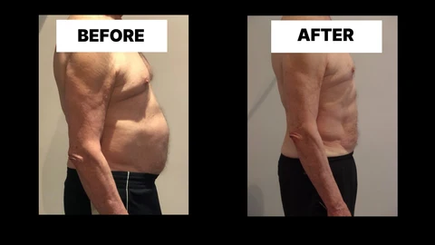 What Symptoms Can Diastasis Recti Cause in Men? Weak Core, Back Pain and Poor Posture West Kilburn